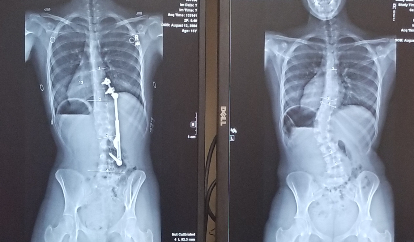 apifix before and after surgery x-rays