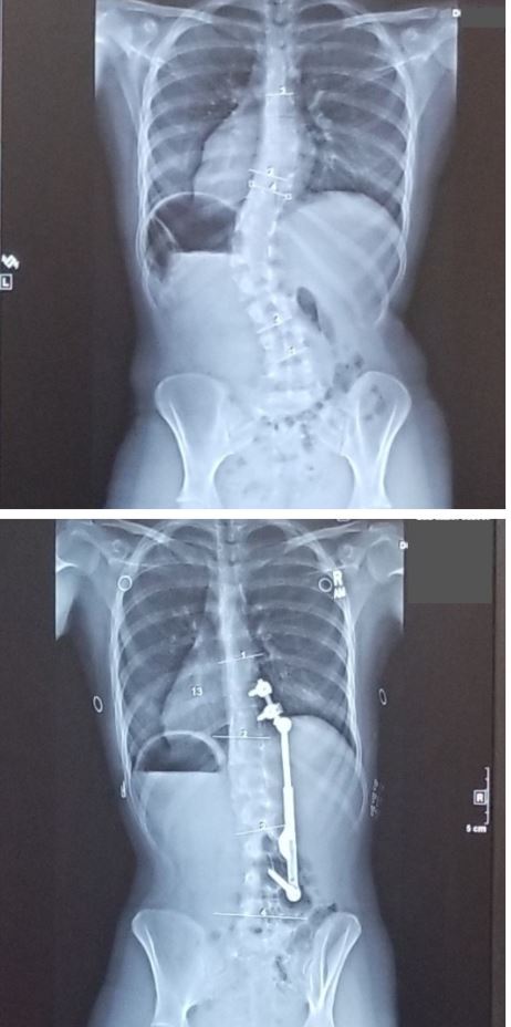before and after x-ray with ApiFix surgery