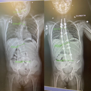 scoliosis before and after surgery x-ray with Dayton Children's 