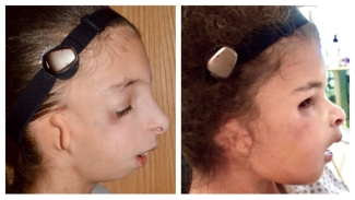 Ava before and after surgery
