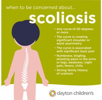 updated when to be concerned about scoliosis