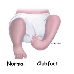 clubfoot