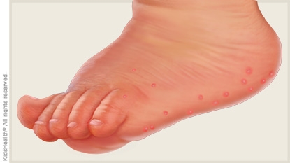hand, foot and mouth disease on foot